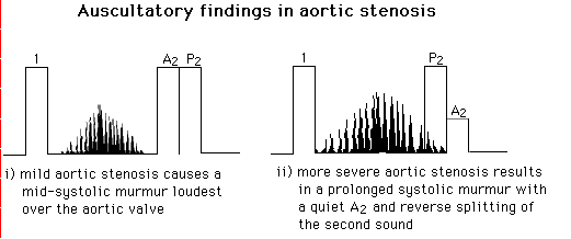 Diagram of the heart sounds in aortic stenosis: mild aortic stenosis causes a mid-systolic murmur loudest over the aortic valve; more severe aortic stenosis results in a prolonged systolic murmur with a quiet A2 and reverse splitting of the second sound.