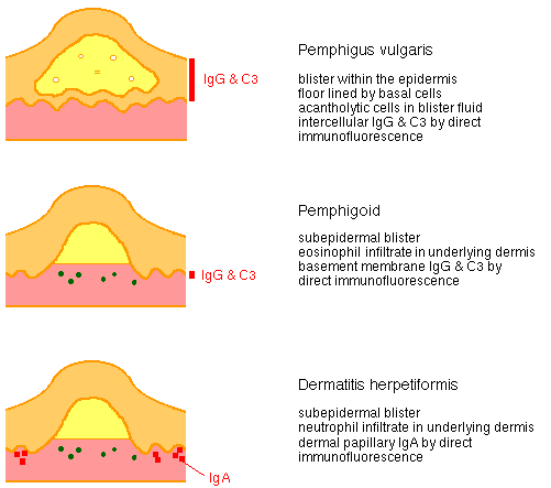 diagram of bullous skin diseases:  pemphigus vulgaris, pemphigoid and dermatitis herpetiformis.