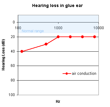 Glue ear results in conduction deafness. The pure tone audiogram shows hearing loss particularly at low frequencies.