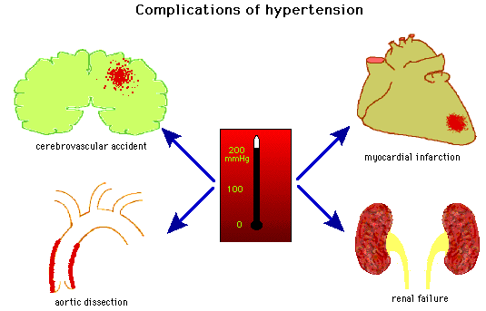 diagram of the complications of hypertension: cerebrovascular accident (stroke), myocardial infarction (heart attack), renal failure and aortic dissection. 