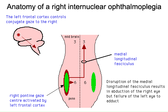 Anatomy of an internuclear ophthalmoplegia.